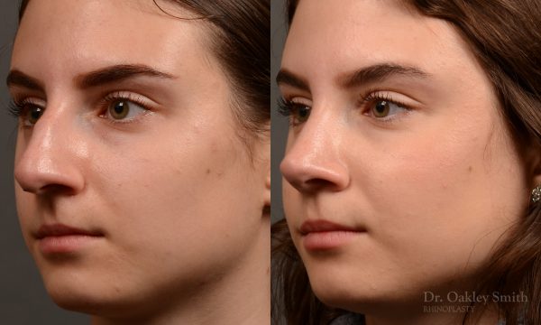 458 rhinoplasty, dr oakley smith, toronto, top surgeon, nose job