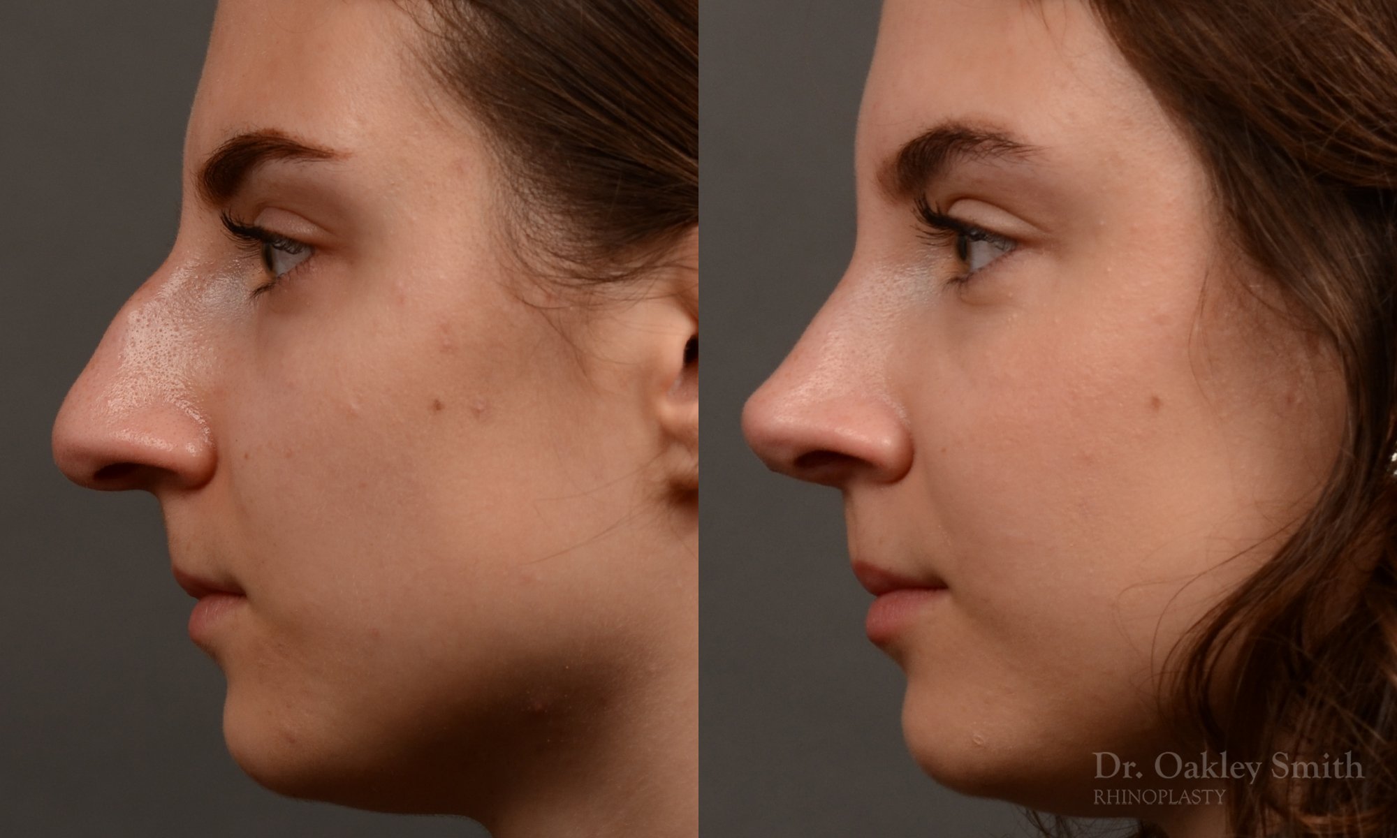 458 rhinoplasty, dr oakley smith, toronto, top surgeon, nose job