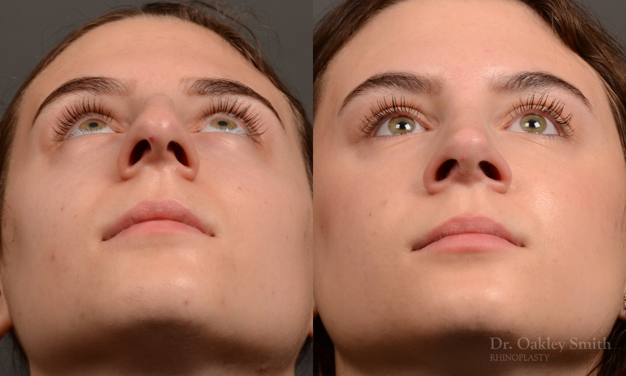 458 rhinoplasty, dr oakley smith, toronto, top surgeon, nose job