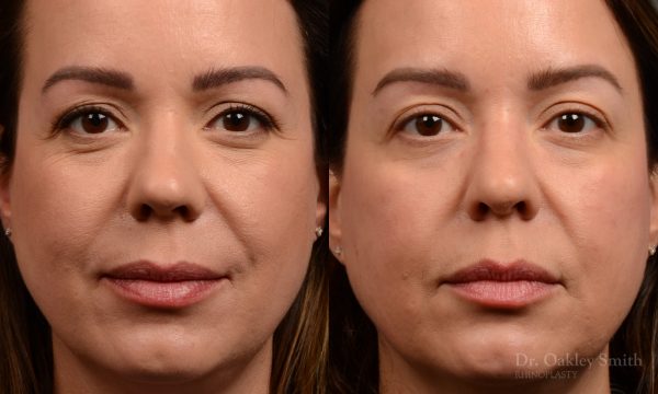 Rhinoplasty - Rhinoplasty Before and After – Case 459