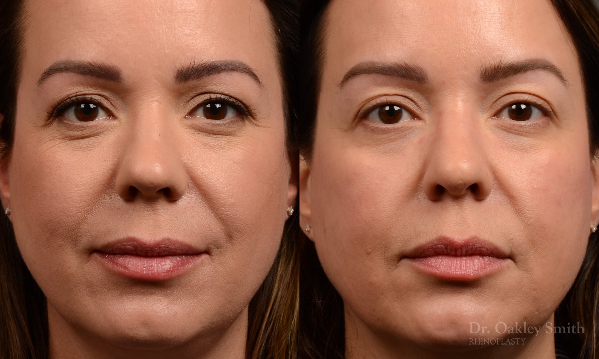 Rhinoplasty - Rhinoplasty Before and After – Case 459