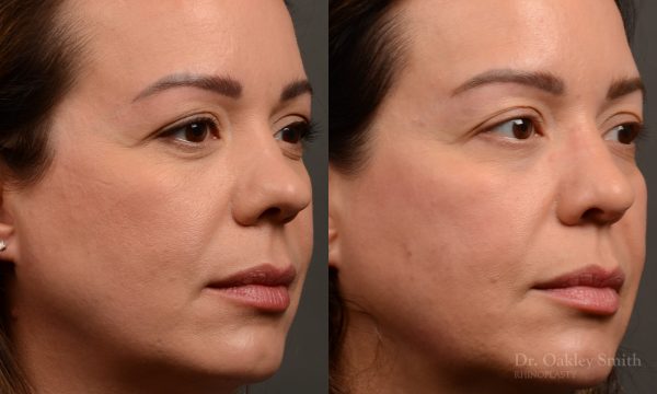 Rhinoplasty - Rhinoplasty Before and After – Case 459
