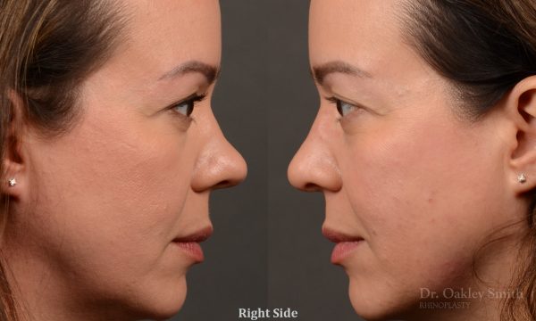 Rhinoplasty - Rhinoplasty Before and After – Case 459
