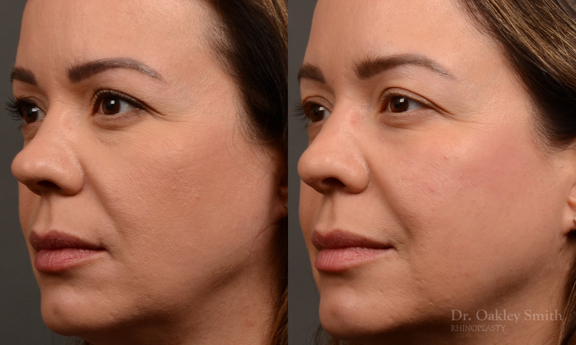 Rhinoplasty - Rhinoplasty Before and After – Case 459