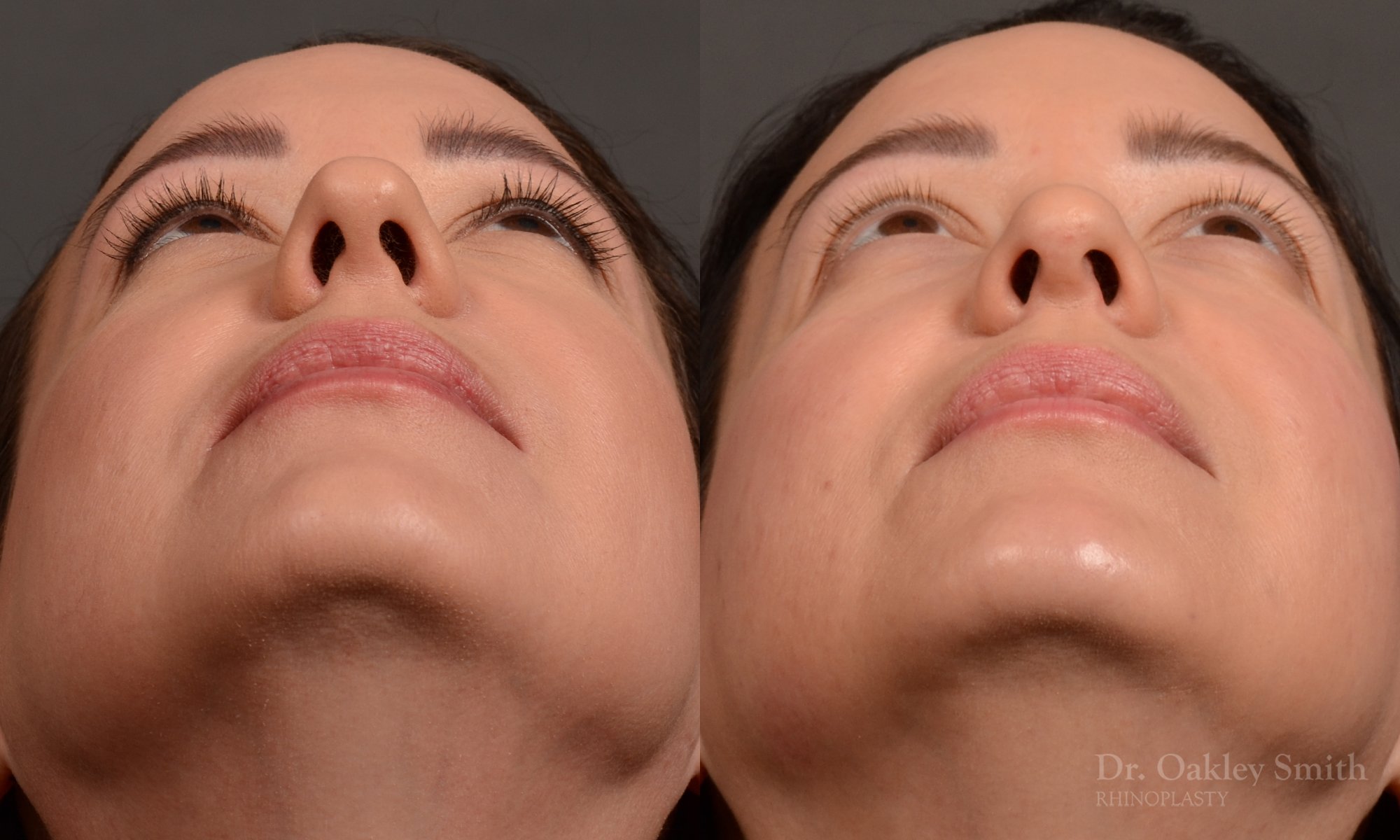 Rhinoplasty - Rhinoplasty Before and After – Case 459