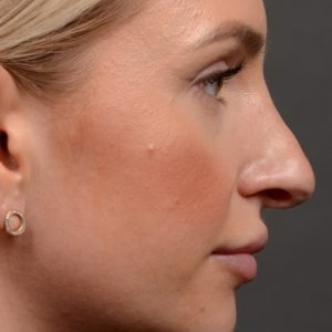 Rhinoplasty - Rhinoplasty Before and After Case 461