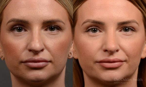 Rhinoplasty - Rhinoplasty Before and After Case 461