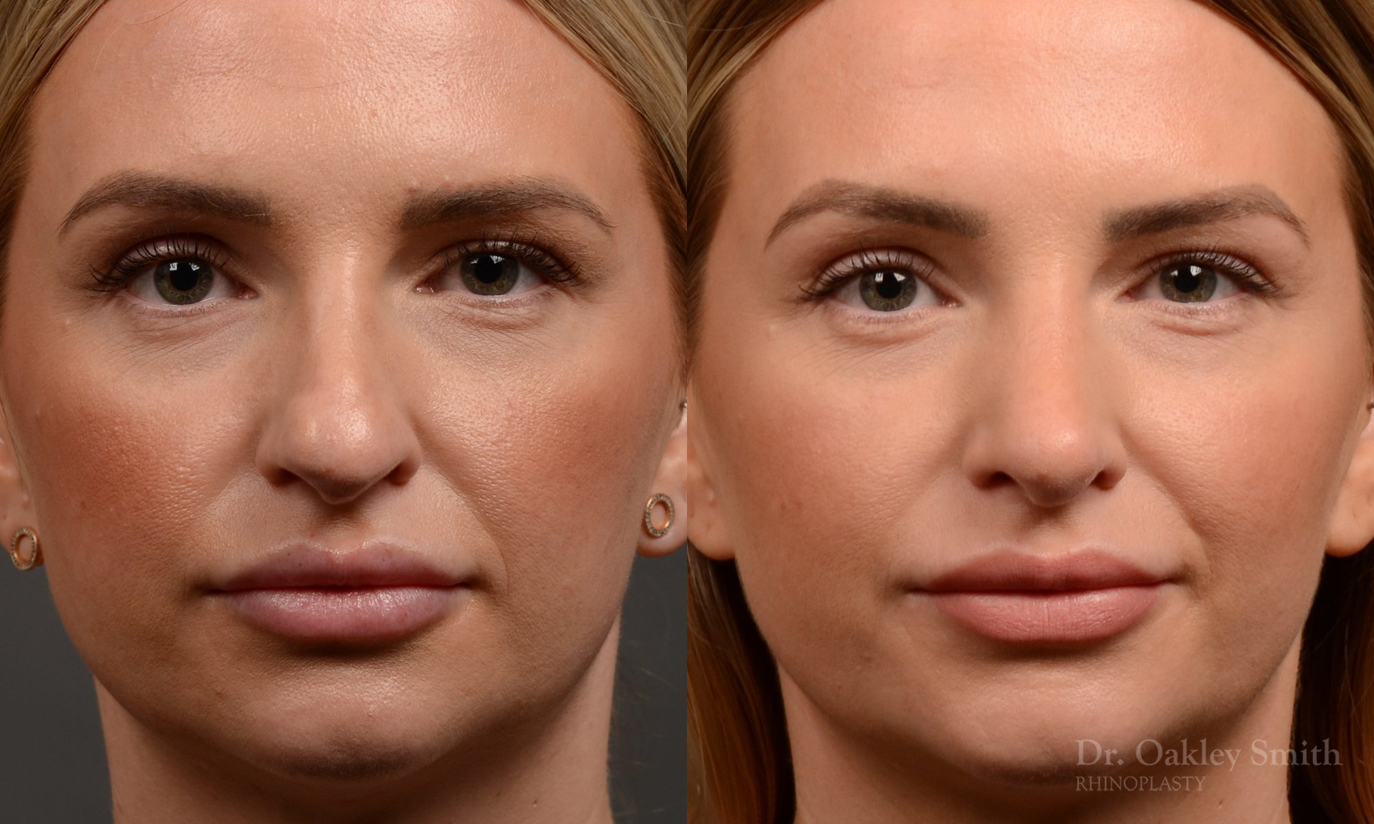 Rhinoplasty - Rhinoplasty Before and After Case 461