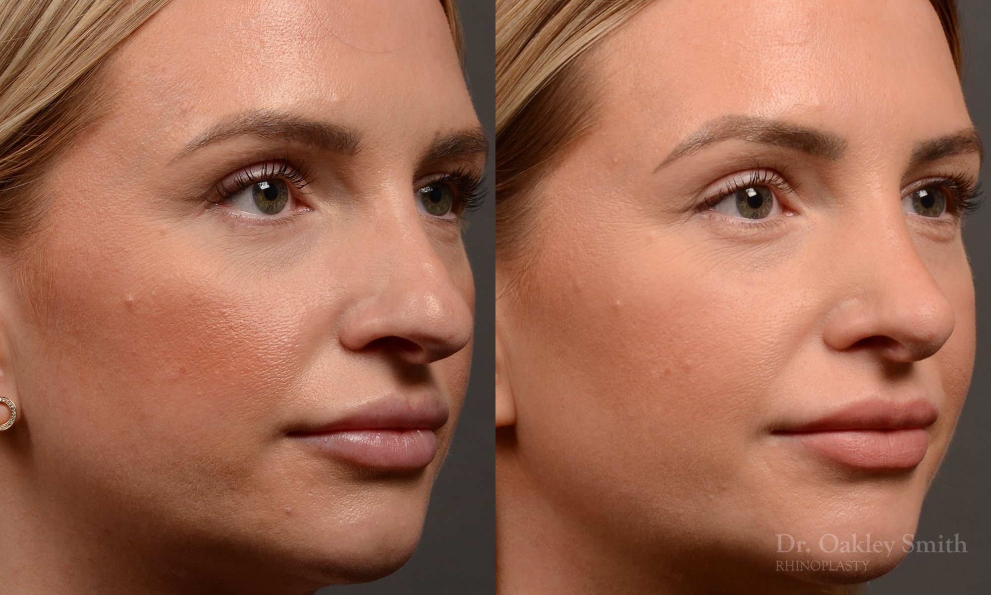 Rhinoplasty - Rhinoplasty Before and After Case 461