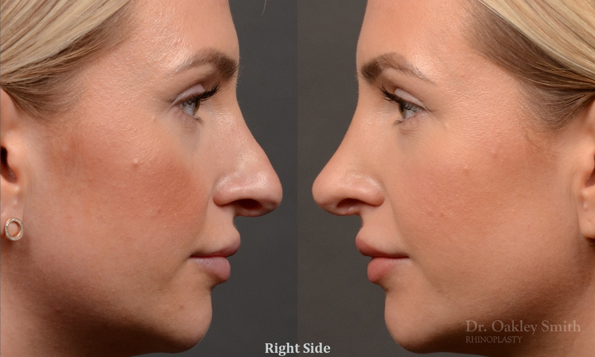 Rhinoplasty - Rhinoplasty Before and After Case 461