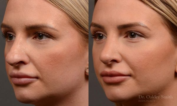 Rhinoplasty - Rhinoplasty Before and After Case 461