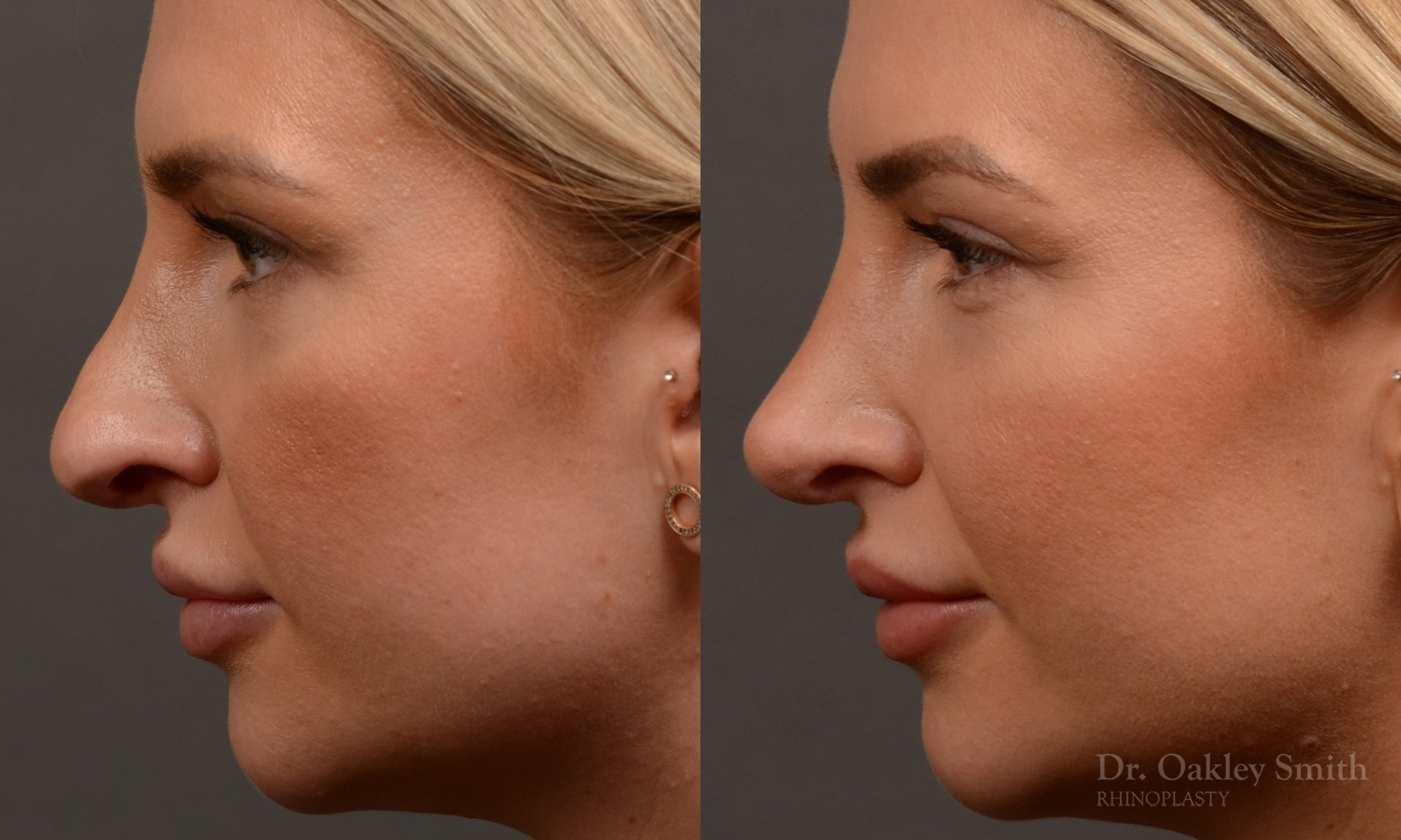 Rhinoplasty - Rhinoplasty Before and After Case 461