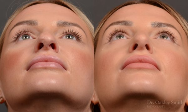 Rhinoplasty - Rhinoplasty Before and After Case 461