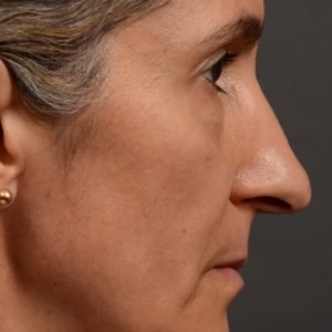 Rhinoplasty - Rhinoplasty Before and After Case 462