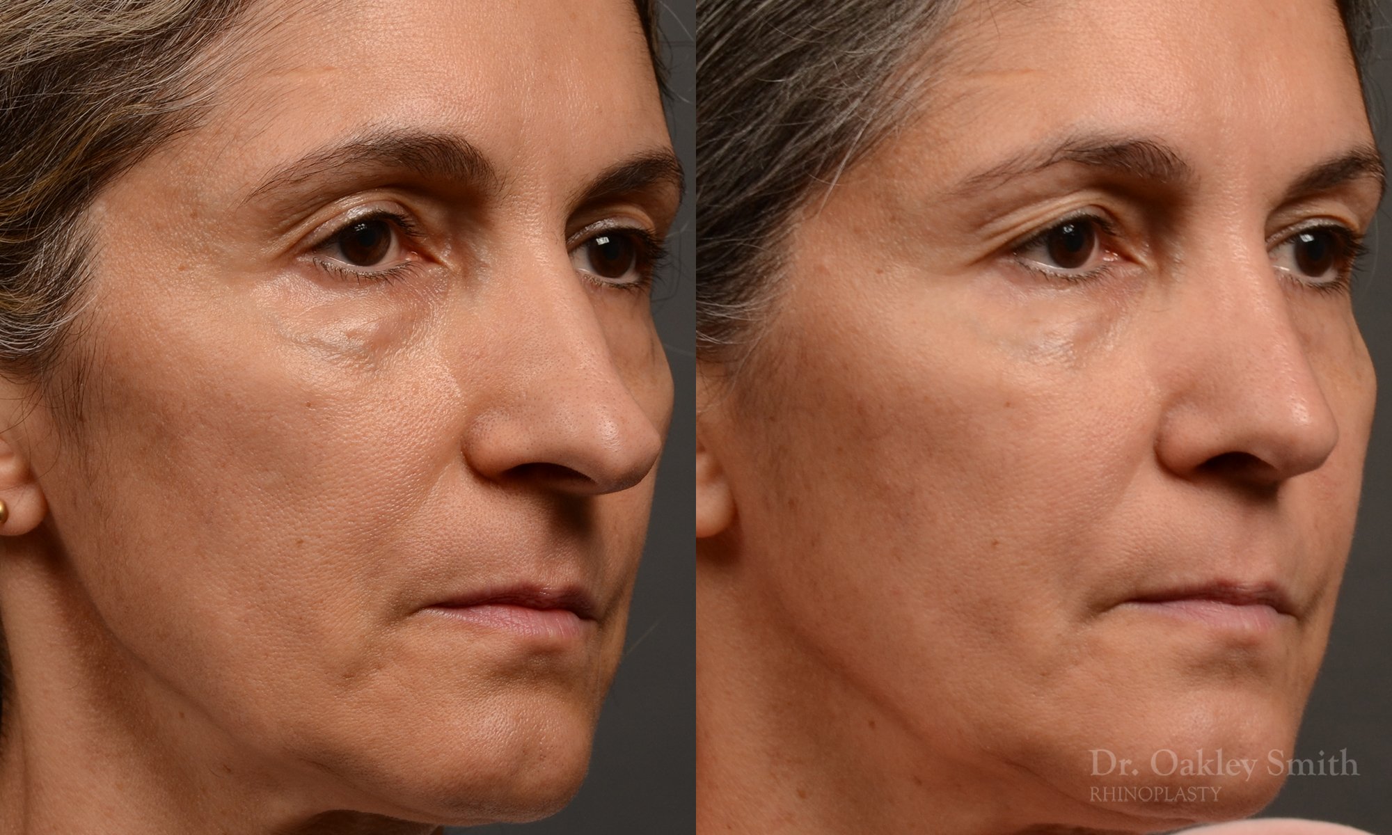 Rhinoplasty - Rhinoplasty Before and After Case 462