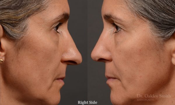Rhinoplasty - Rhinoplasty Before and After Case 462