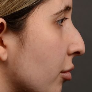 Rhinoplasty - Auto Draft