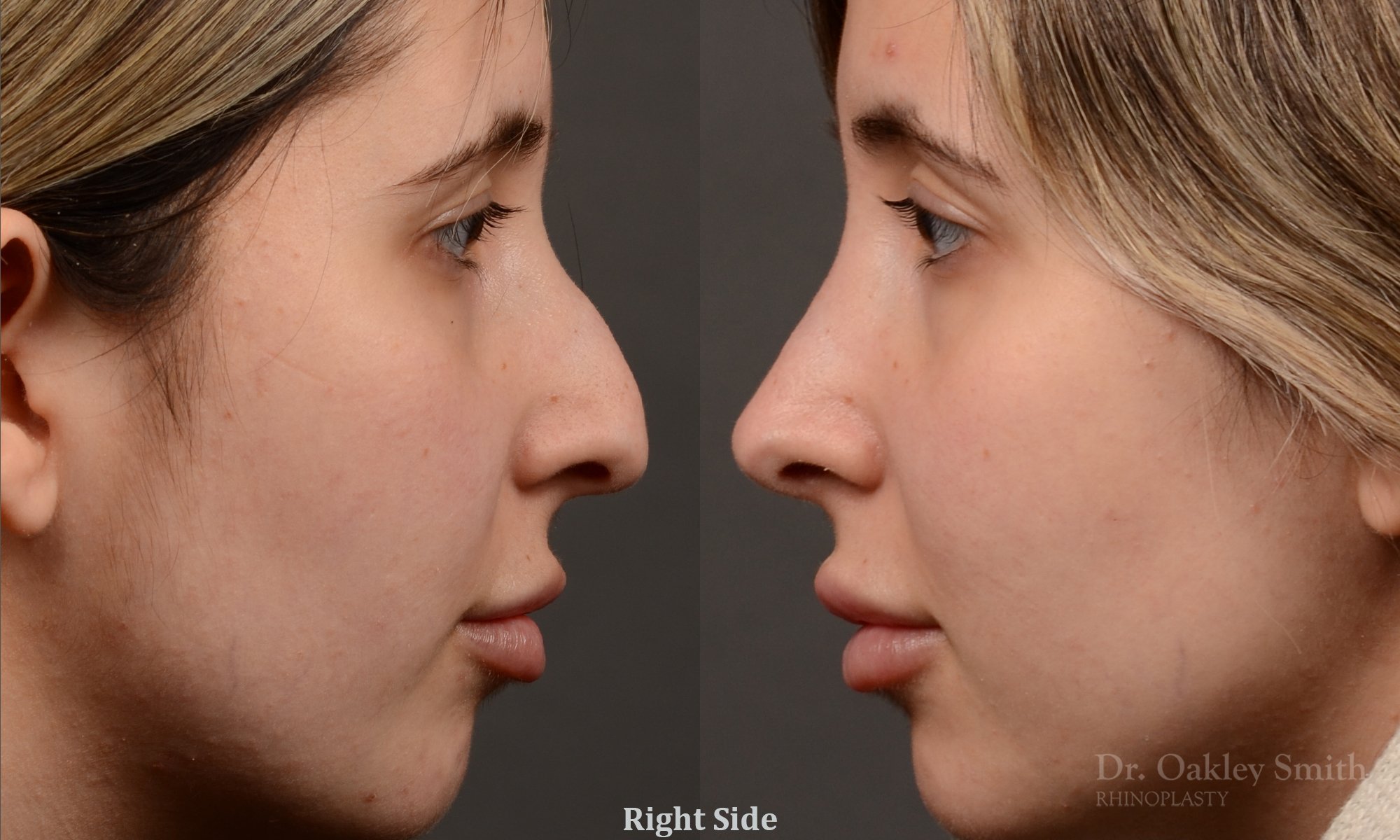 Rhinoplasty - Auto Draft