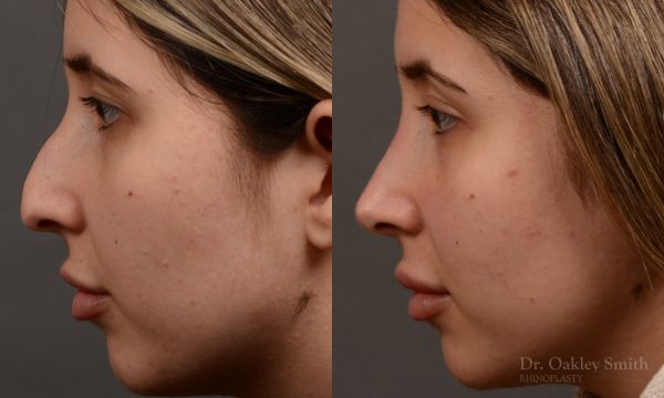 Rhinoplasty - Auto Draft