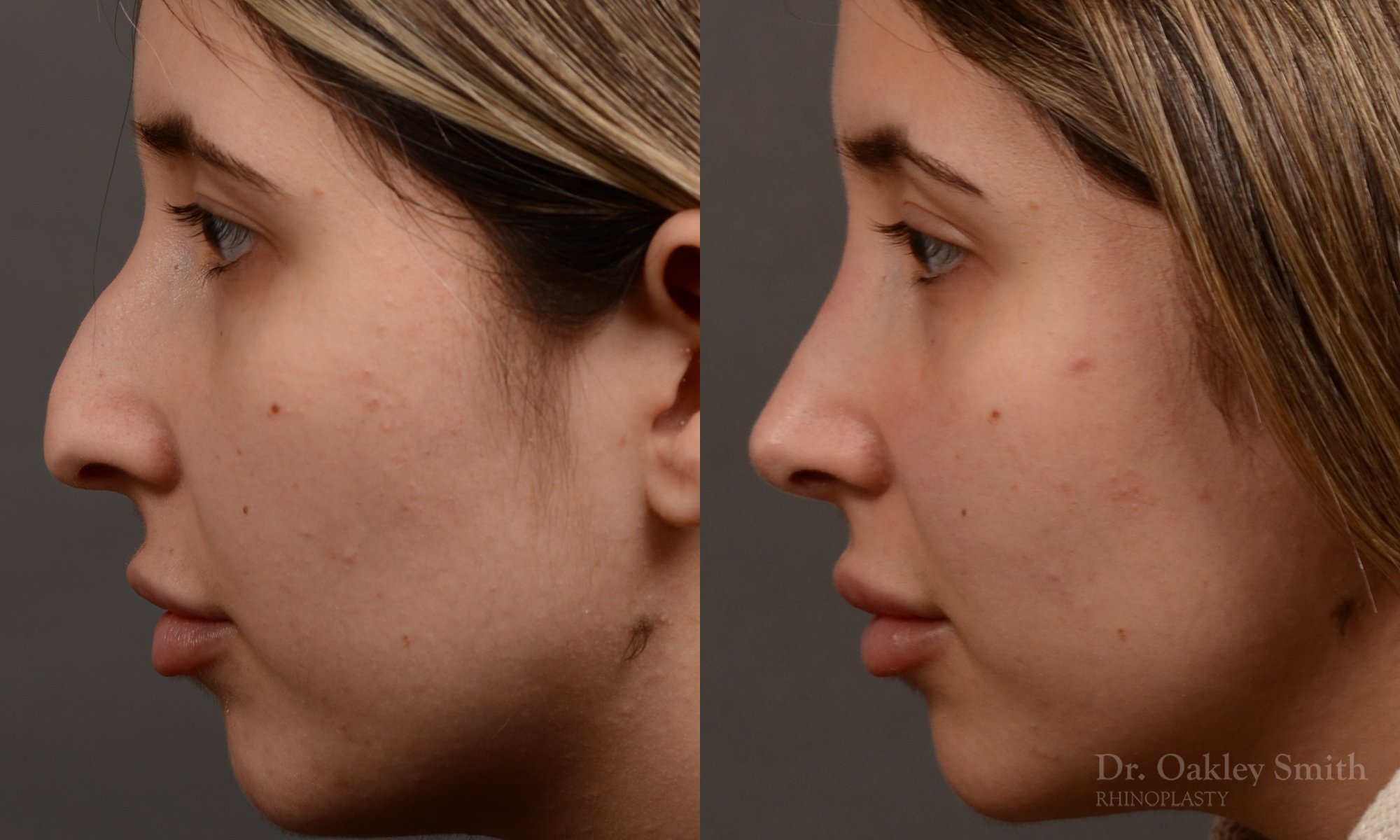 Rhinoplasty - Auto Draft