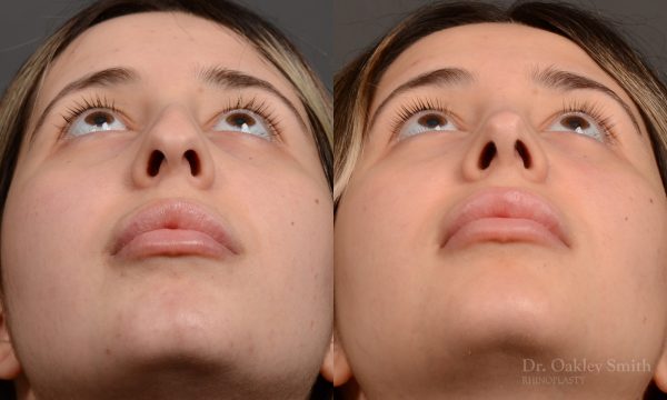 Rhinoplasty - Auto Draft