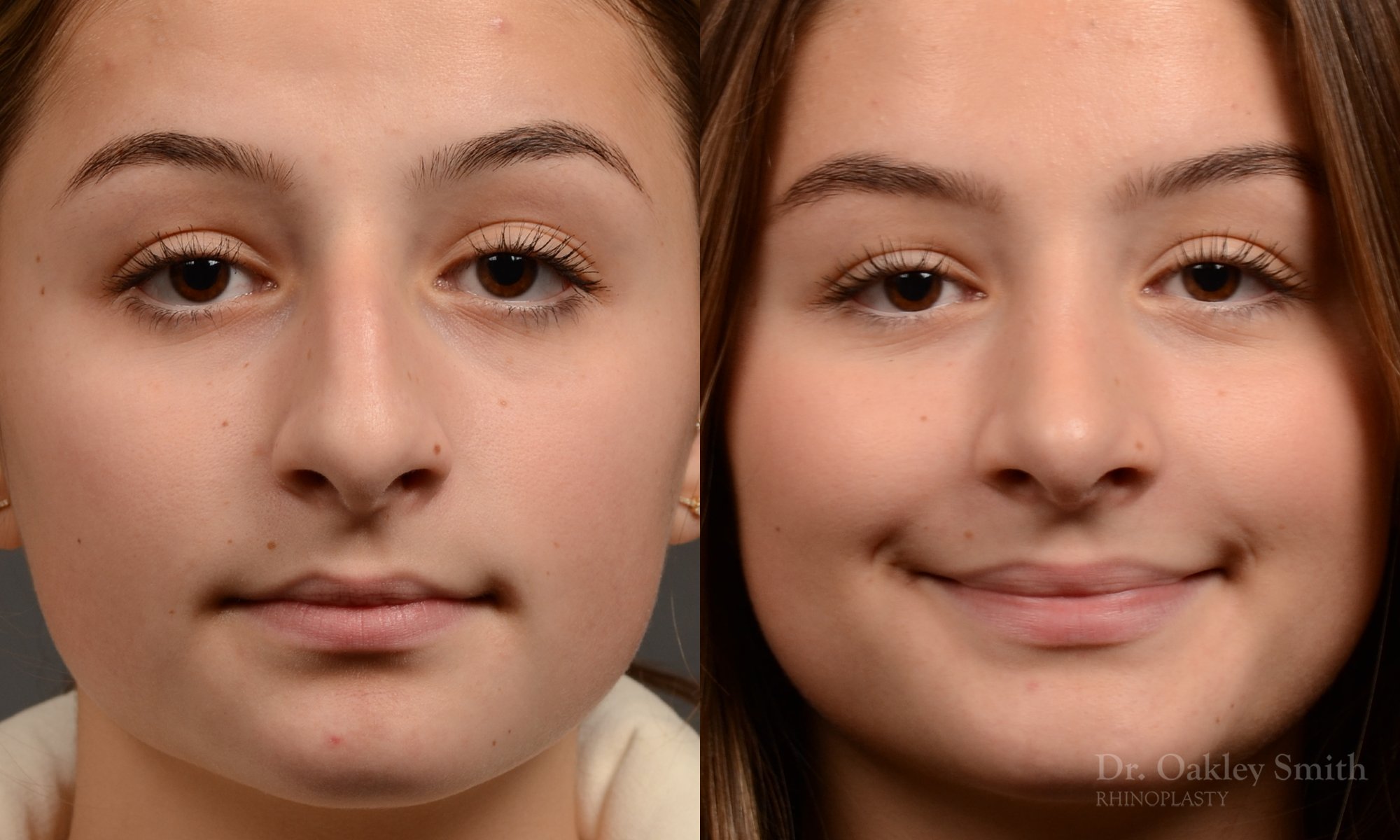 Rhinoplasty - Rhinoplasty Before and After – Case 464