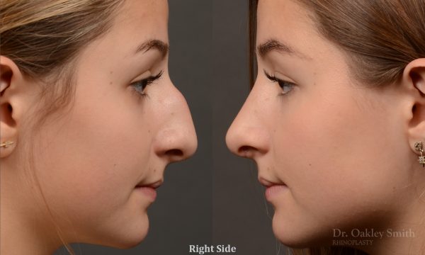 Rhinoplasty - Rhinoplasty Before and After – Case 464