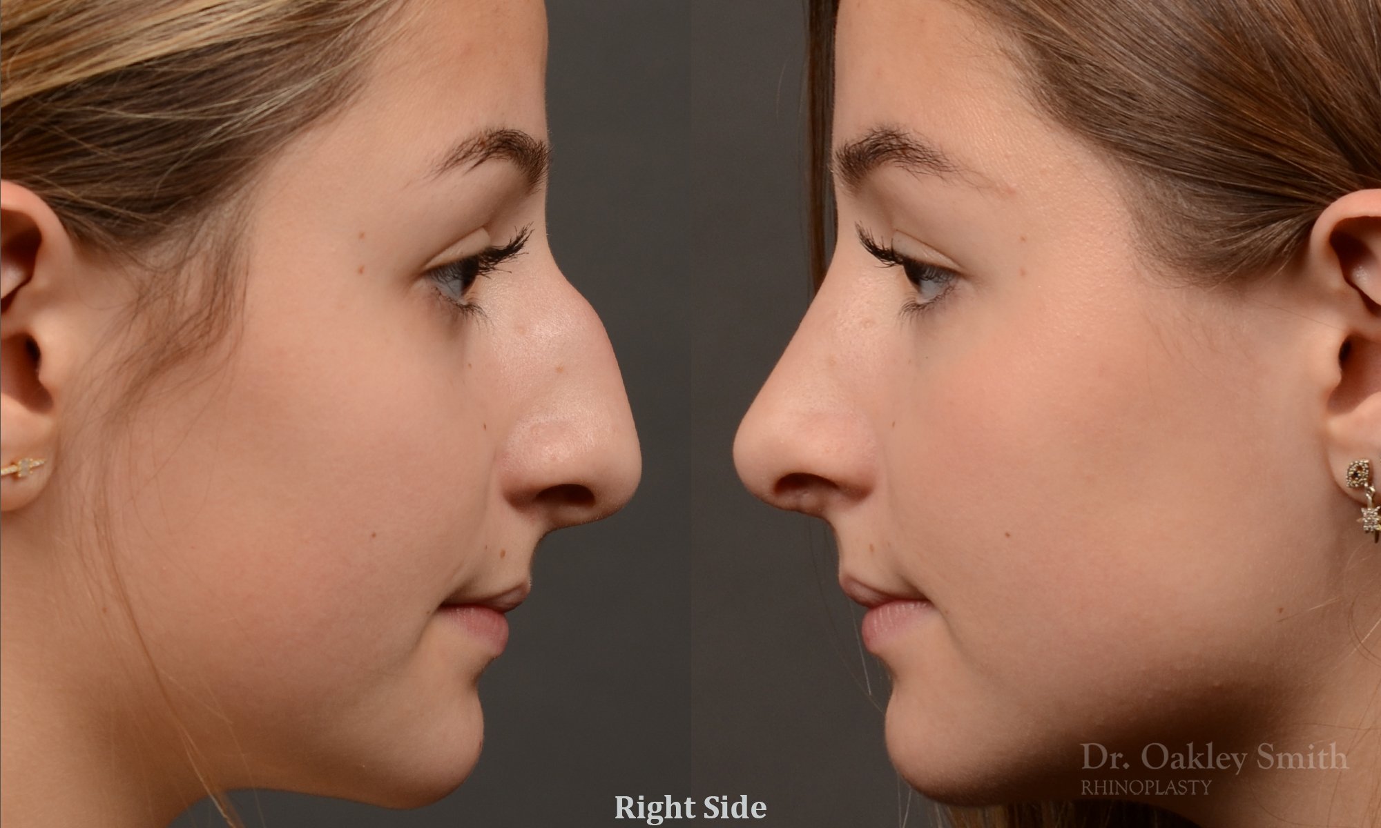 Rhinoplasty - Rhinoplasty Before and After – Case 464
