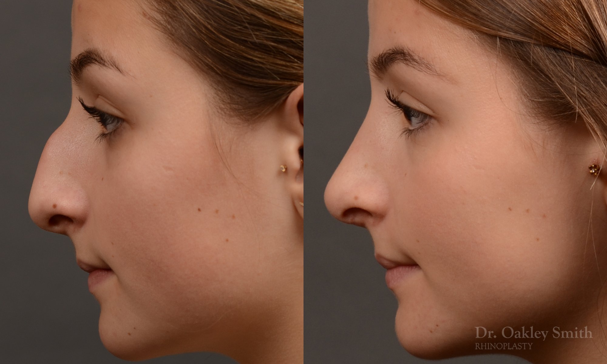 Rhinoplasty - Rhinoplasty Before and After – Case 464