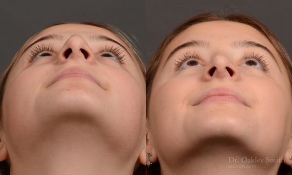 Rhinoplasty - Rhinoplasty Before and After – Case 464