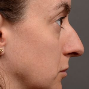 Rhinoplasty - Rhinoplasty Before and After Case 465