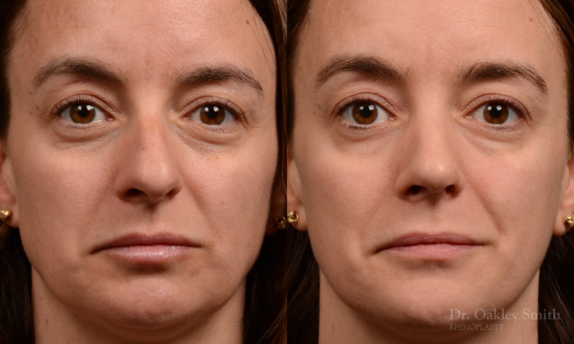 Rhinoplasty - Rhinoplasty Before and After Case 465