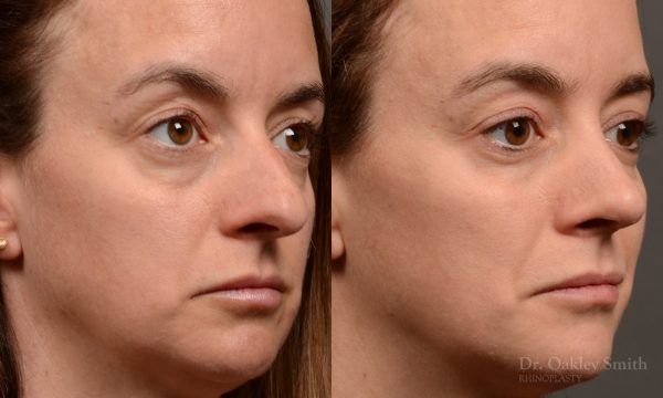 Rhinoplasty - Rhinoplasty Before and After Case 465