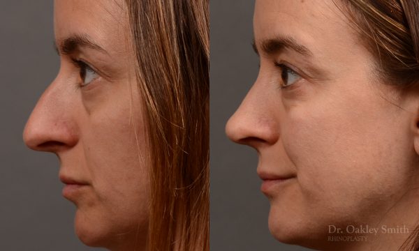 Rhinoplasty - Rhinoplasty Before and After Case 465