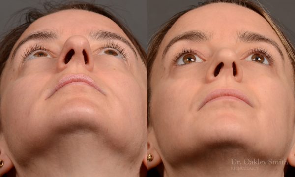 Rhinoplasty - Rhinoplasty Before and After Case 465