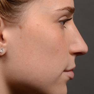 Rhinoplasty - Rhinoplasty Before and After Case 466