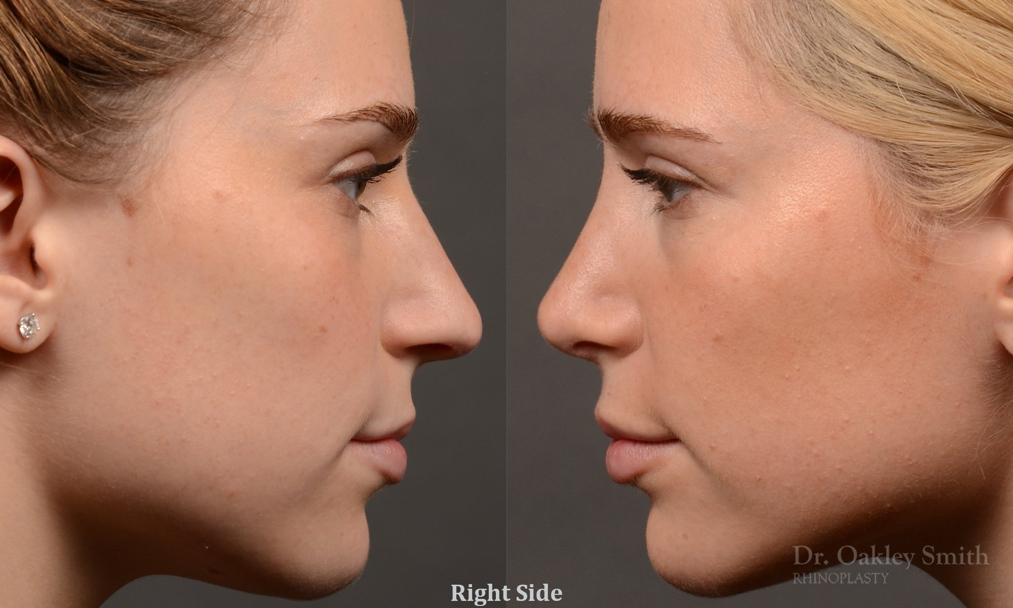 Rhinoplasty - Rhinoplasty Before and After Case 466
