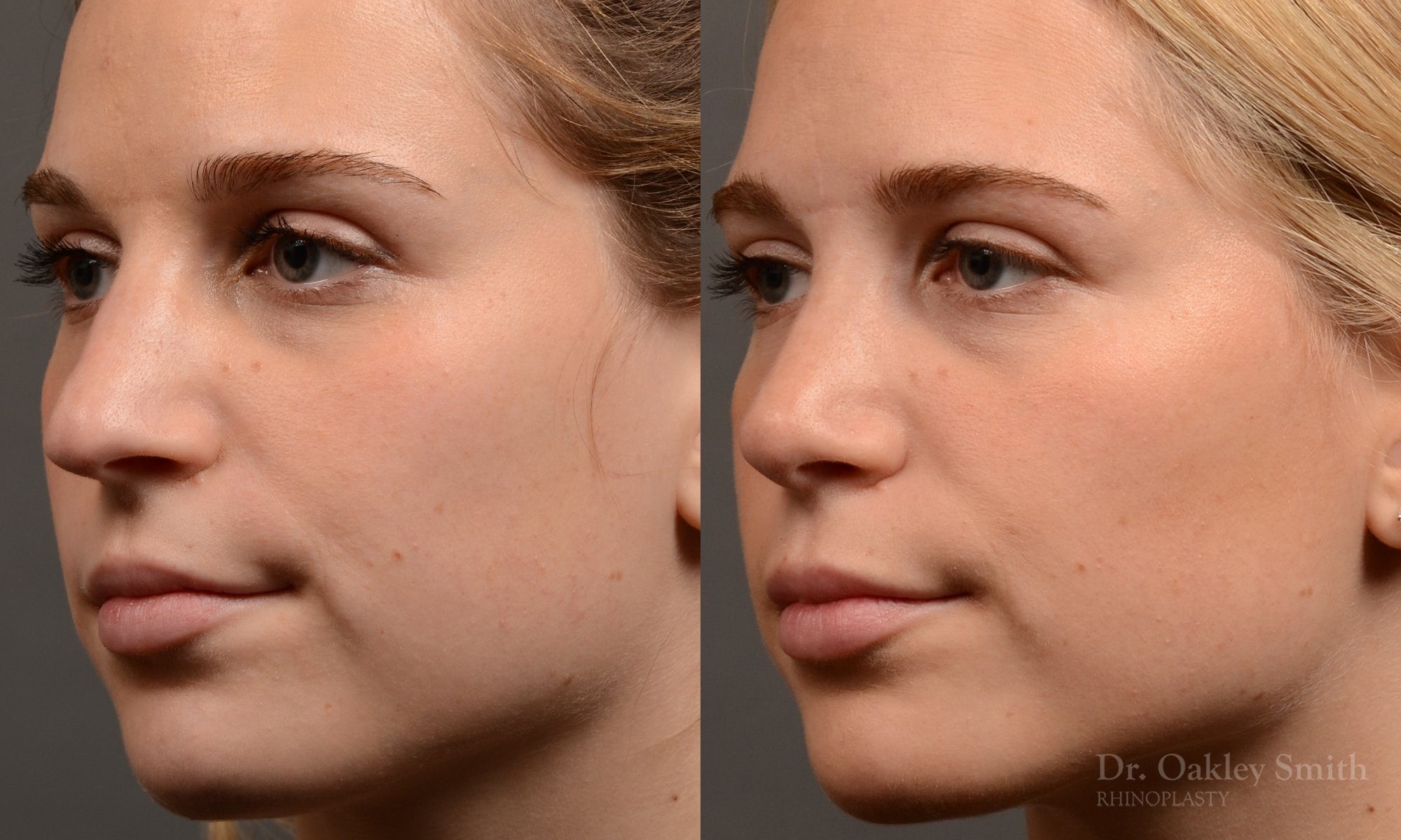 Rhinoplasty - Rhinoplasty Before and After Case 466