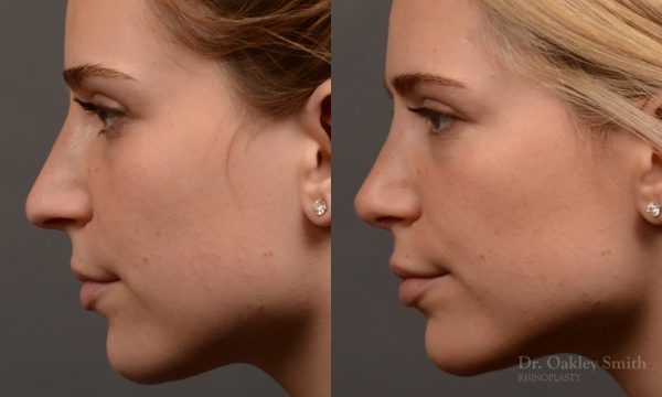 Rhinoplasty - Rhinoplasty Before and After Case 466