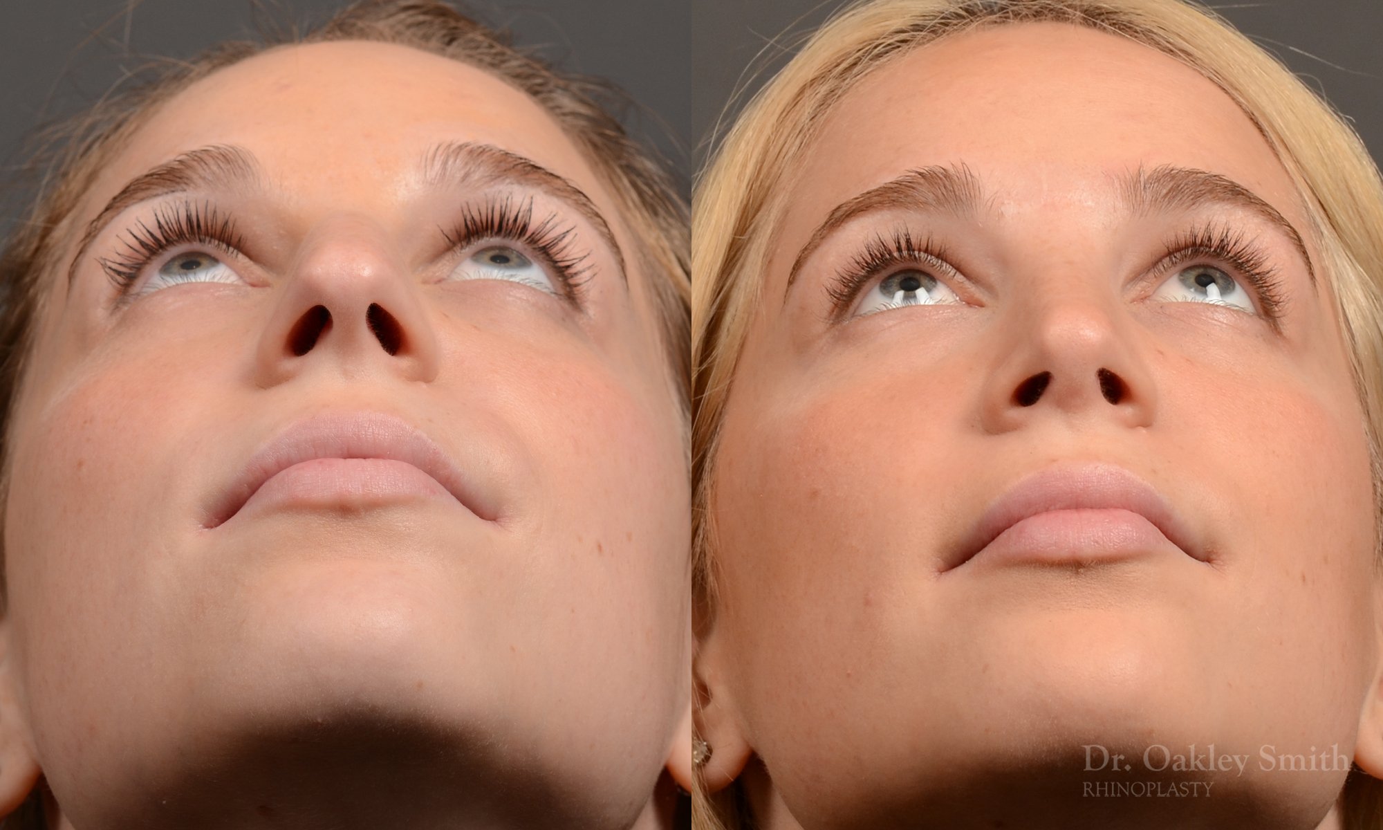 Rhinoplasty - Rhinoplasty Before and After Case 466