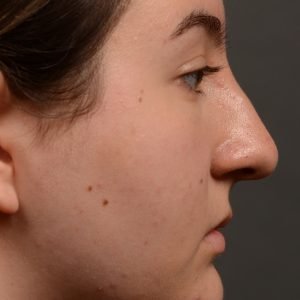 Rhinoplasty - Rhinoplasty Before and After – Case 467