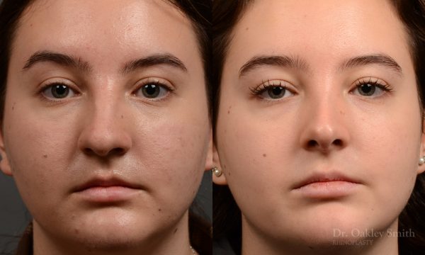 Rhinoplasty - Rhinoplasty Before and After – Case 467