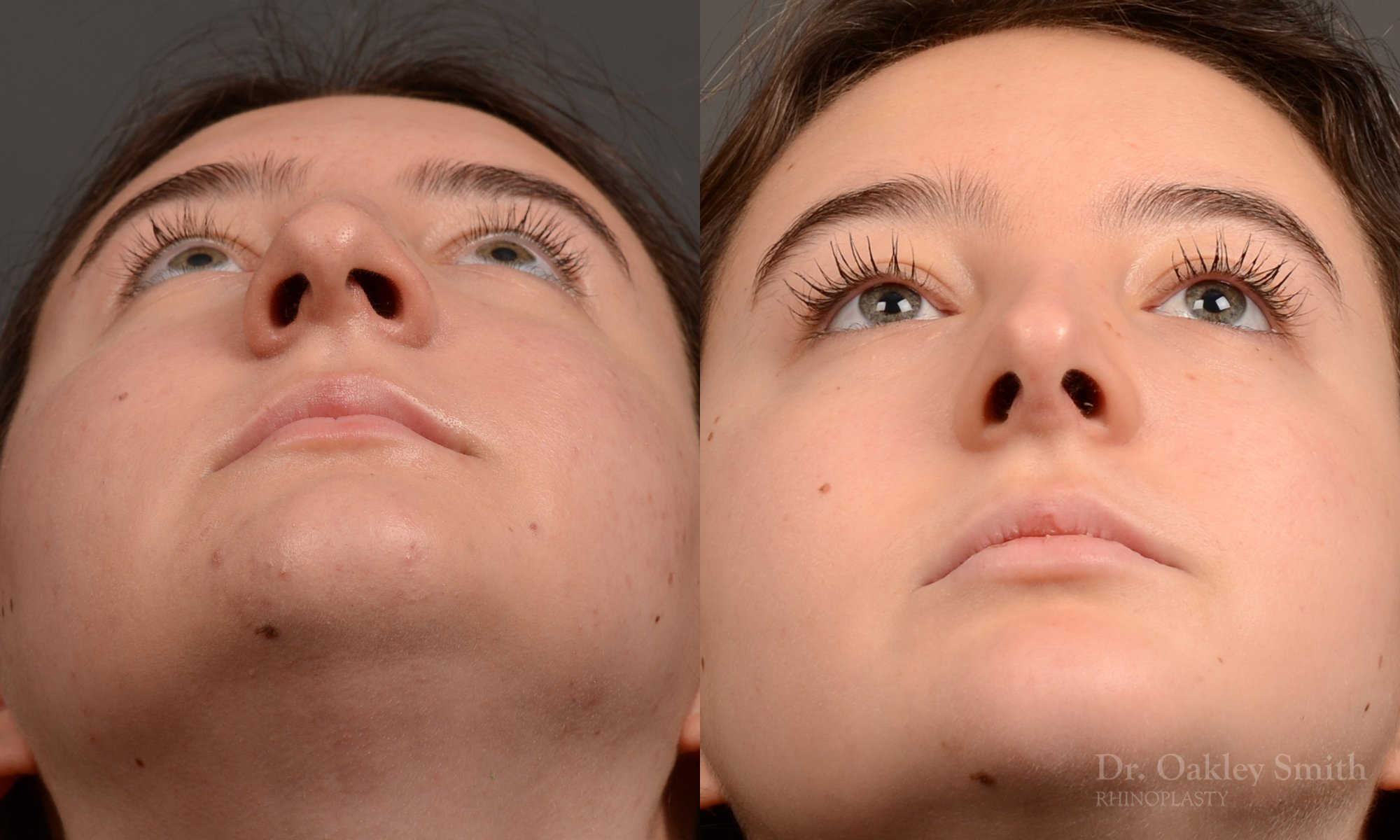 Rhinoplasty - Rhinoplasty Before and After – Case 467