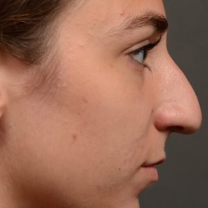 Rhinoplasty - Rhinoplasty Before After – Case 468