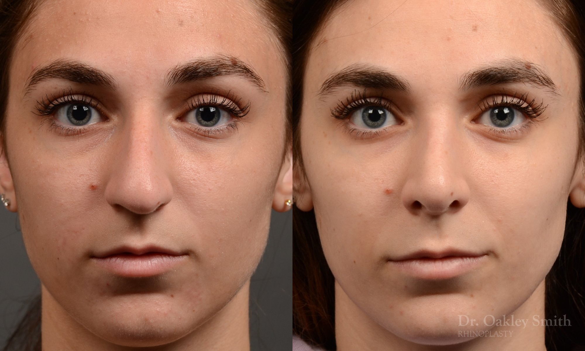 Rhinoplasty - Rhinoplasty Before After – Case 468