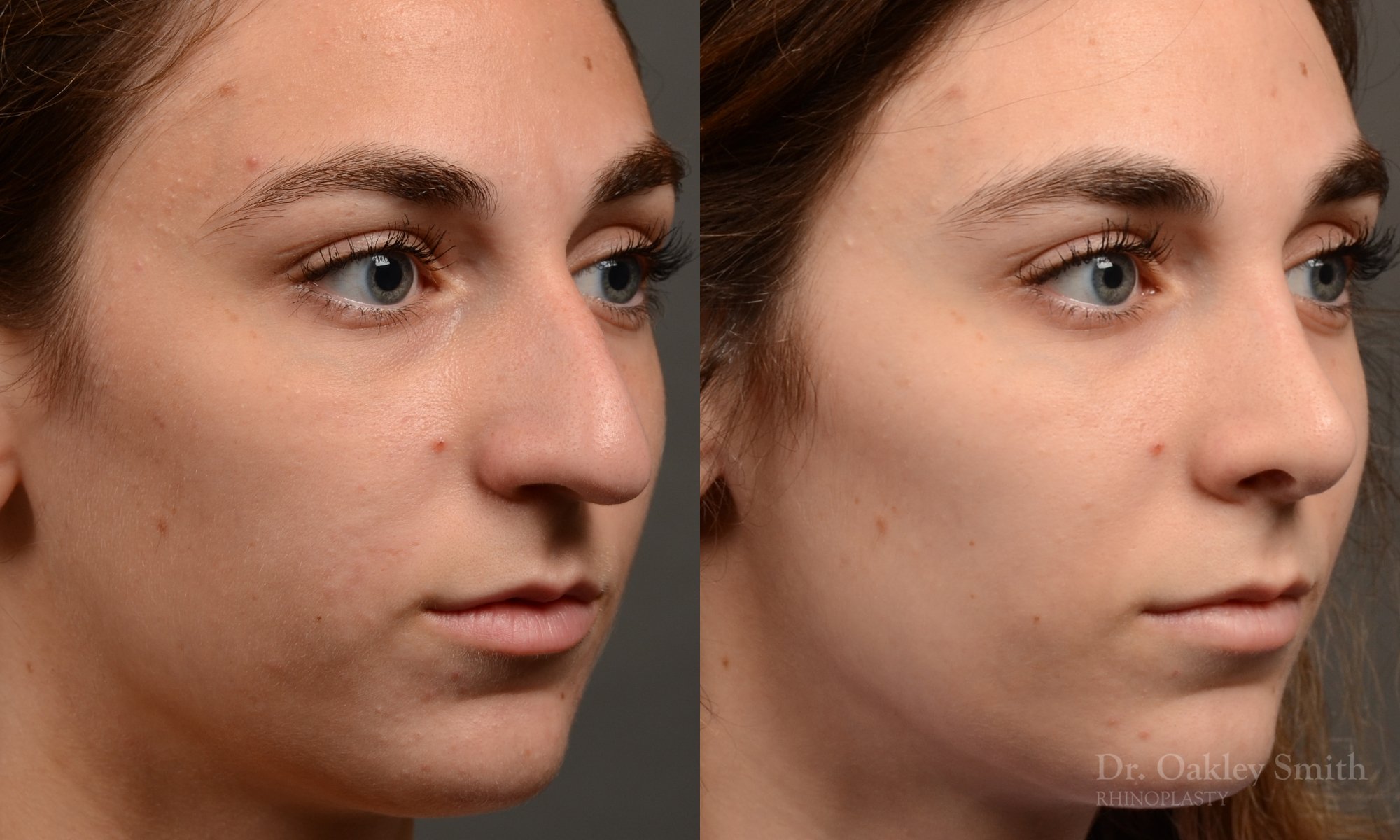 Rhinoplasty - Rhinoplasty Before After – Case 468