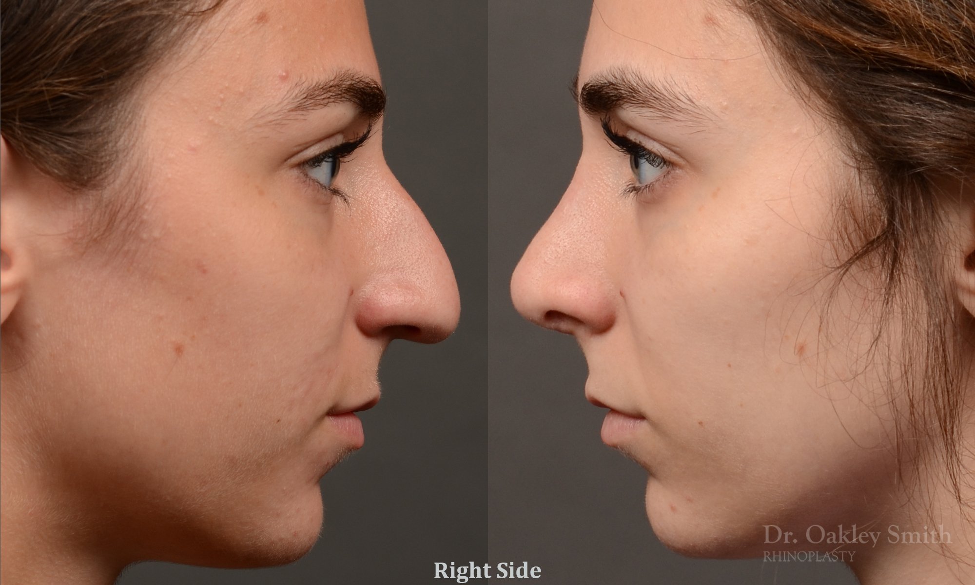 Rhinoplasty - Rhinoplasty Before After – Case 468