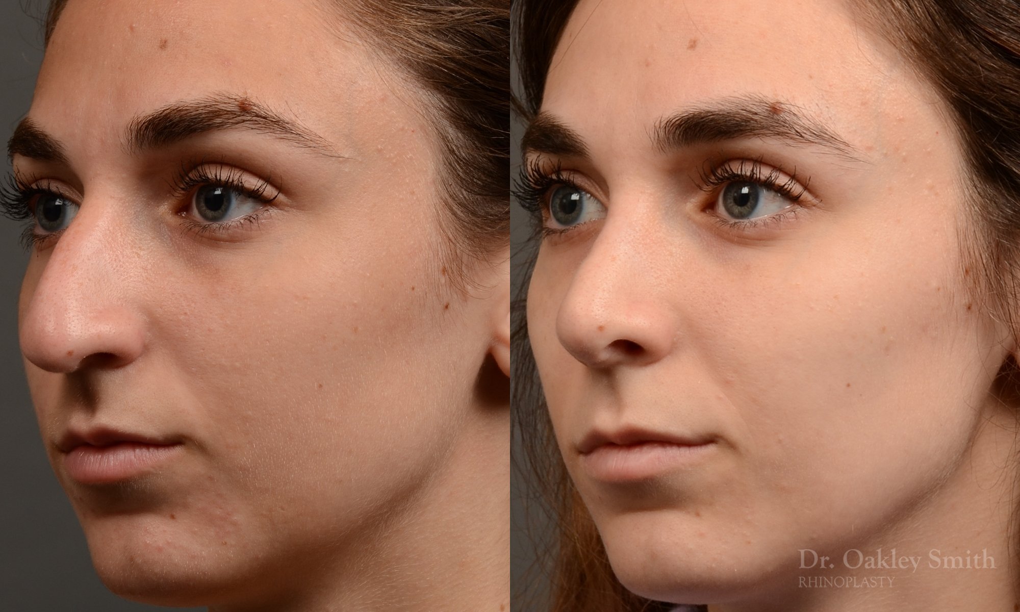 Rhinoplasty - Rhinoplasty Before After – Case 468