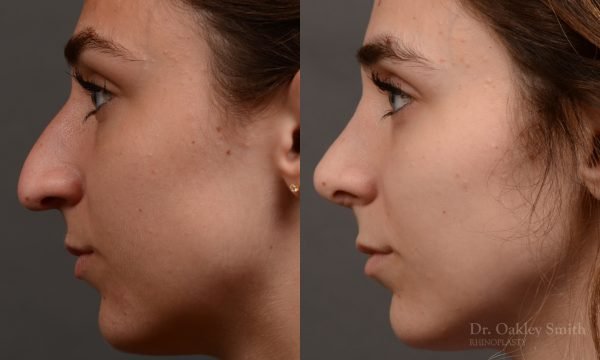 Rhinoplasty - Rhinoplasty Before After – Case 468