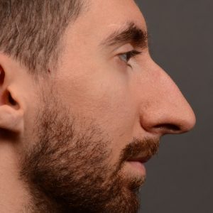 Rhinoplasty - Rhinoplasty Before and After Case 469